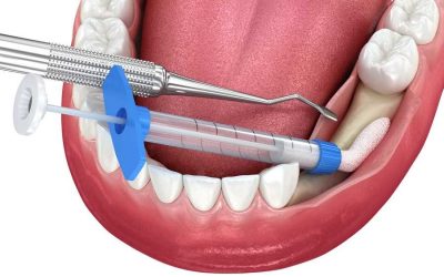 Революционный метод имплантации зубов — безболезненная и безопасная замена зубов без сверления кости