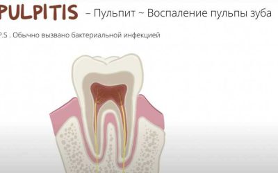Сверление зуба — основные этапы и процедуры для выявления заболеваний и их лечения