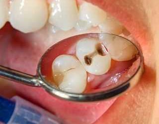Почему возникает специфический запах при сверлении зуба — причины и возможные последствия