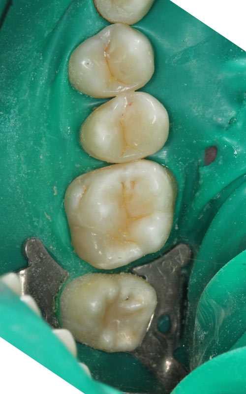 Художественная реставрация 14,15,16 и 18 зубов