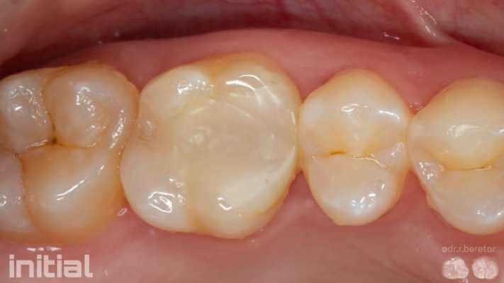 Прямая реставрация 16 зуба