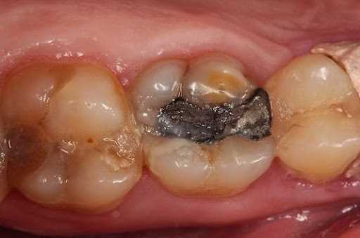 Восстановление 16 зуба с помощью композитной вкладки