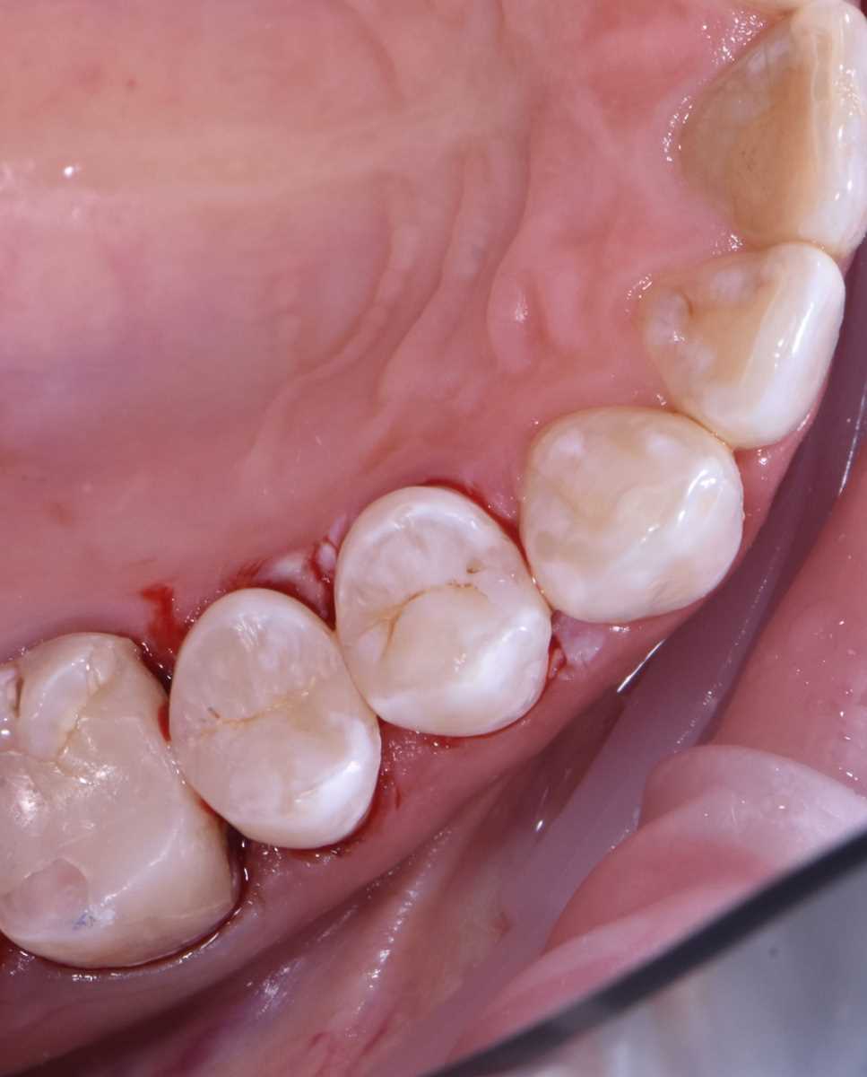 Как и зачем провести реставрацию 16 зуба — основные этапы