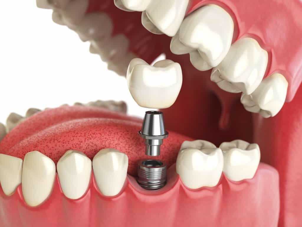 3D имплантация зубов по хирургическому шаблону