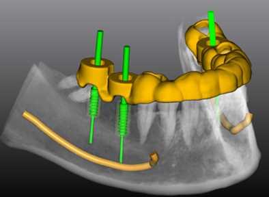 Имплантация зубов в 3D