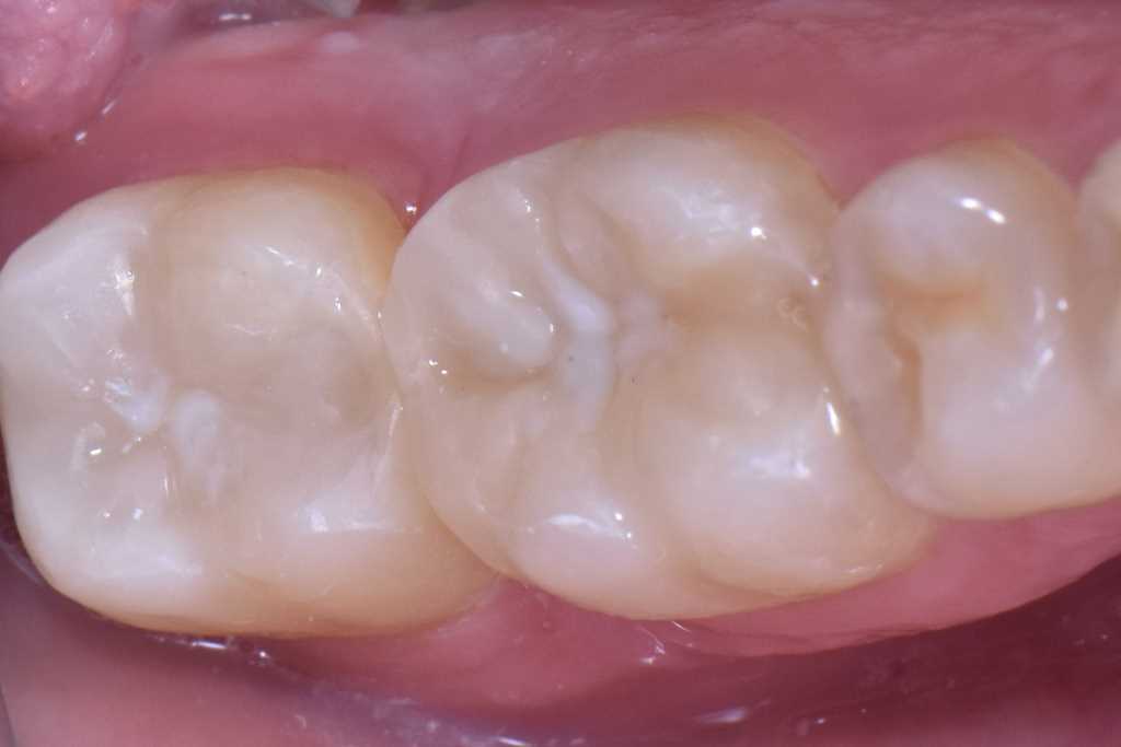 Реставрация зуба. Клинический случай №36