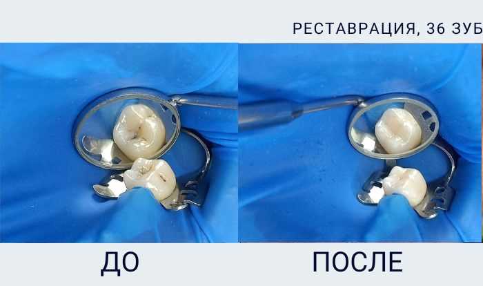 36 зуб реставрация