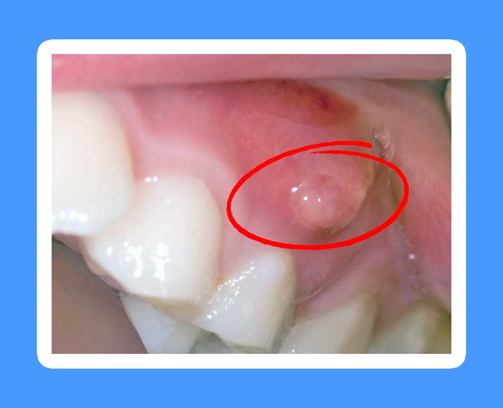 Особенности лечения абсцесса зуба