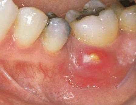 Абсцесс после удаления зуба — причины, симптомы и методы лечения