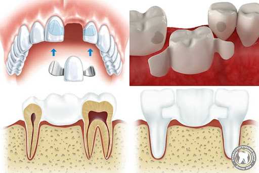 Адгезивная реставрация зубов