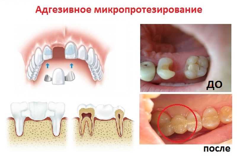 Адгезивное протезирование зубов