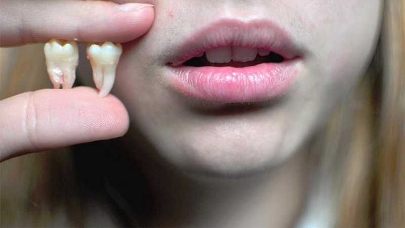 Удаление зубов под общим наркозом