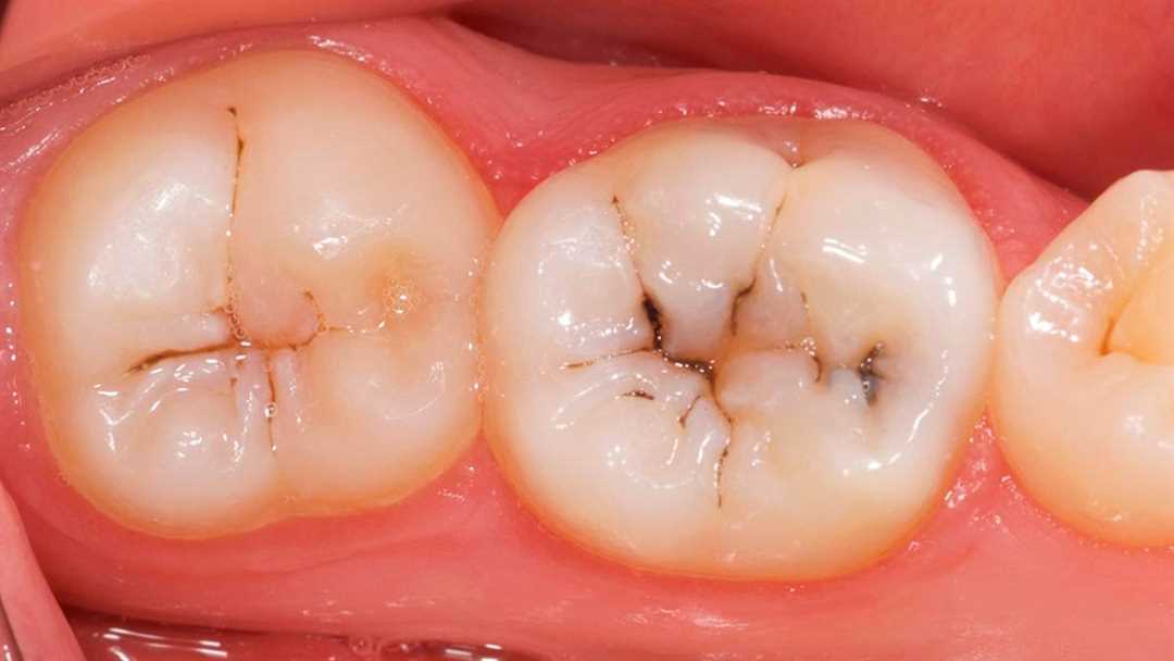 Актуальность проблемы кариеса зубов и неотложность его эффективного лечения в современном мире