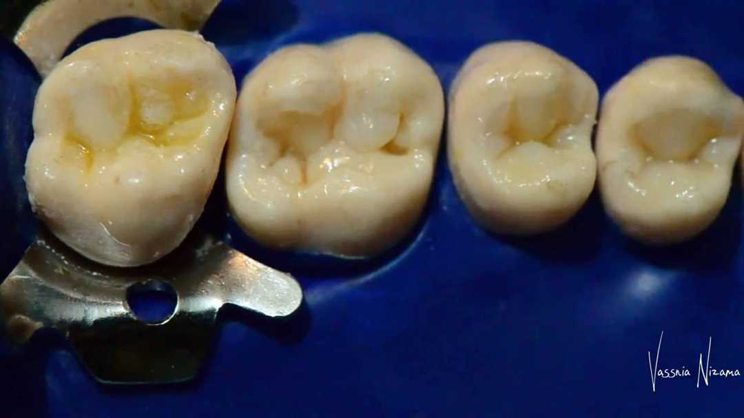 Анатомия жевательных зубов для реставрации