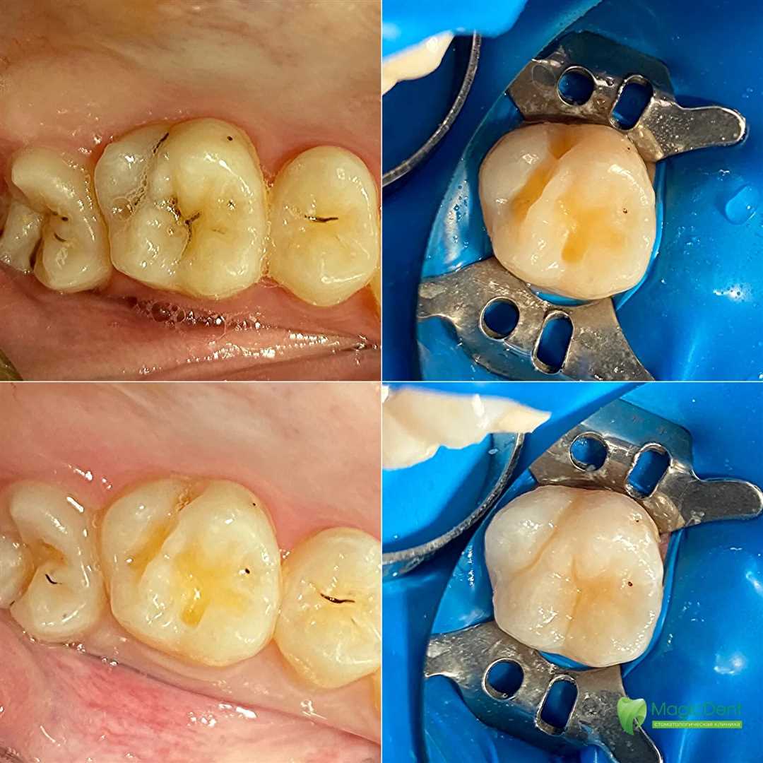 Анестезия при удалении шестнадцати зубов — принципы, процедура и последствия