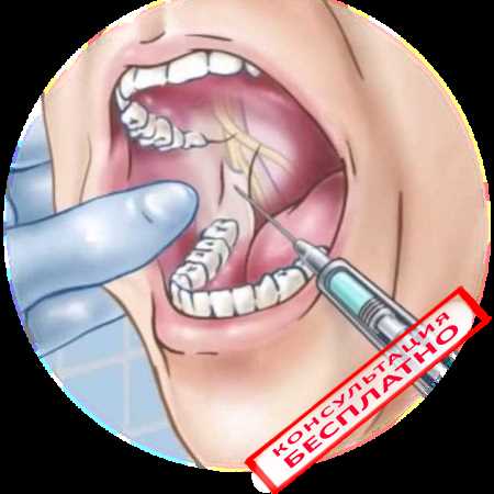 Анестезия при имплантации зубов