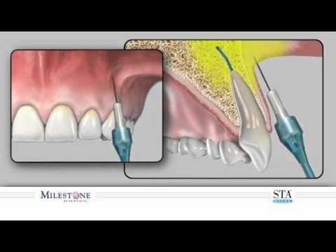 Анестезия при процедурах зубного лечения после операции по удалению менингиомы