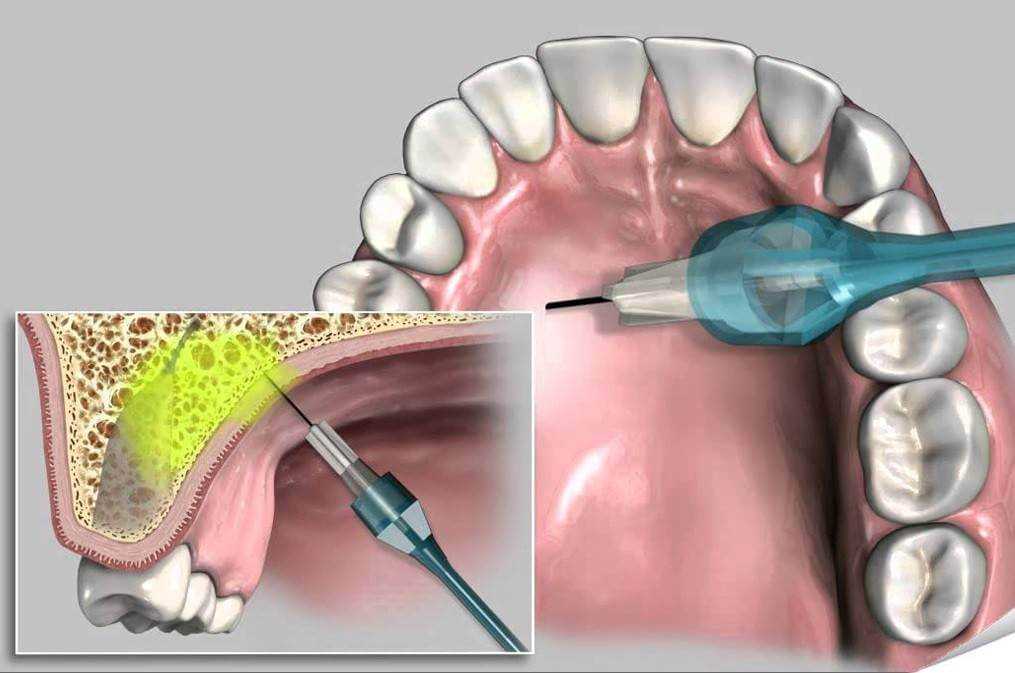 Анестезия для безопасного и безболезненного удаления зуба — процедура, варианты и современные методы