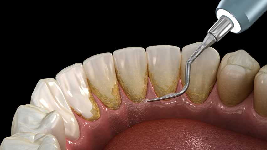 Критерии качества при чистке зубов от камня