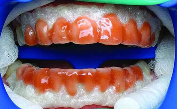 Анестезия при удалении зубного камня — важность проведения процедуры безболезненно и комфортно