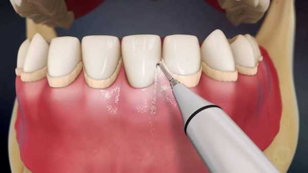 Насадка №3 к ультразвуковому скалеру для удаления зубного камня