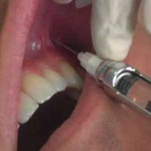 Особенности проведения местной аппликационной анестезии в стоматологии