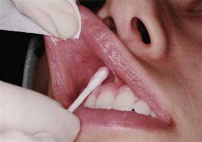 Аппликационная анестезия зуба — методы, преимущества, последствия