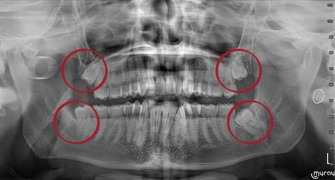 Атипичное удаление 8-го зуба осложненное в клинике Profident Junior