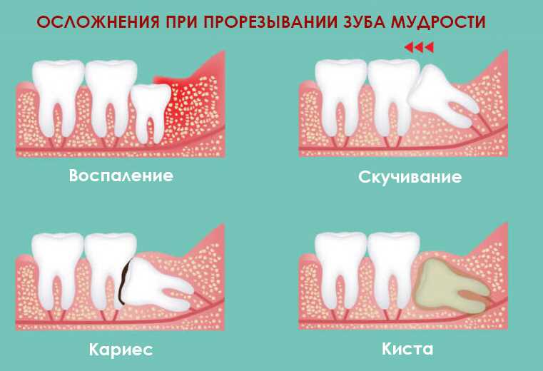Атипичное удаление зубов