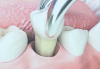 Атравматичное удаление зубов