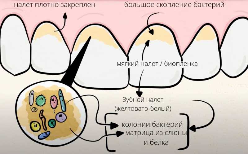 Бактериальный зубной налет