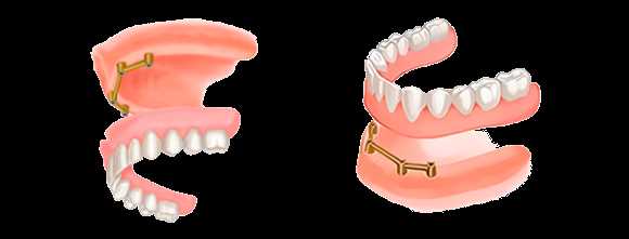 Балочное протезирование зубов — эффективный и надежный способ восстановления зубной рядности