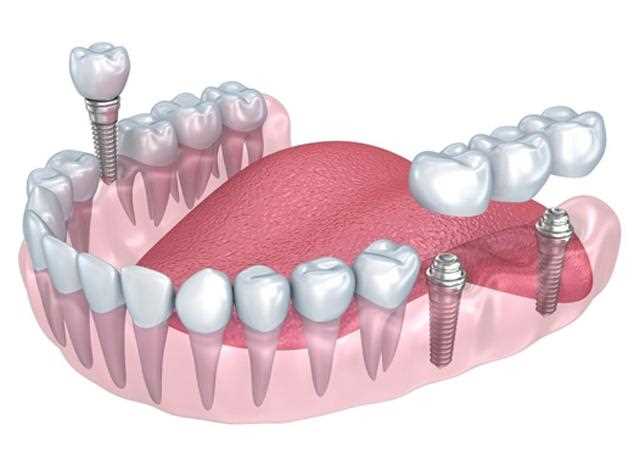 Что такое базальная имплантация зубов
