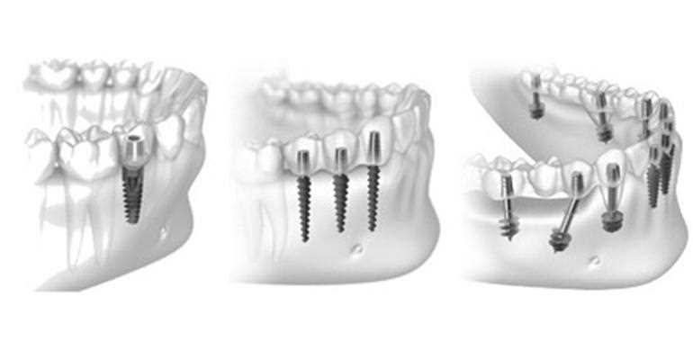 Базальная имплантация зубов цены, плюсы и минусы метода