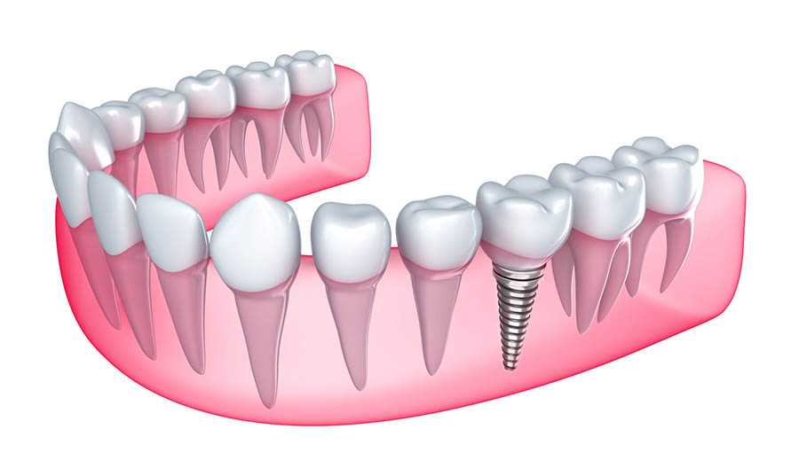 Базальное протезирование зубов