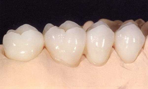 Безметалловые протезы зубов — современные решения для эффективного протезирования
