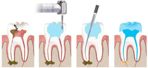 Биологическое лечение острого очагового пульпита — активация регенерации и восстановление здоровья зубов