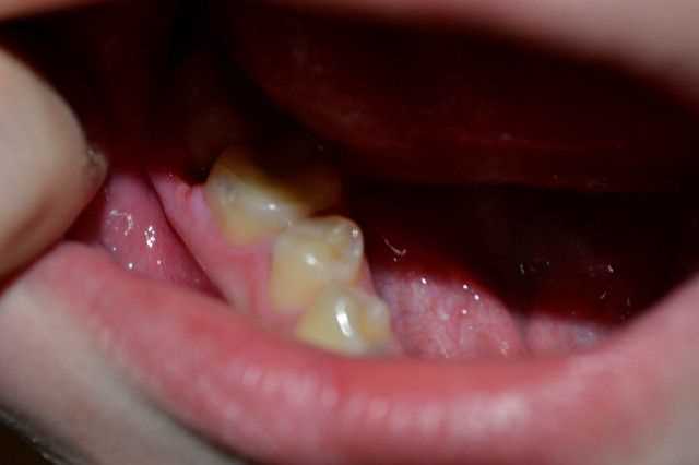 Боль после анестезии зуба