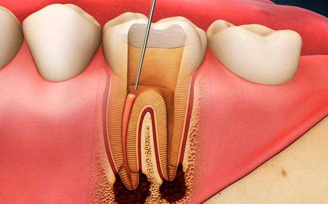 Боль при сверлении зуба