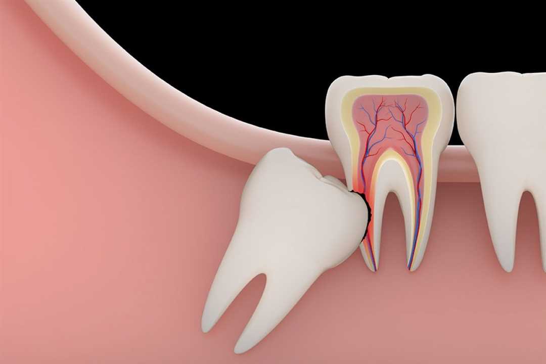 Боль зуб снять удаление