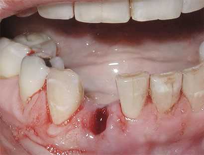 Что делать, если болят десна после зубного удаления