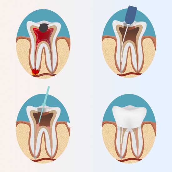 Почему может болеть зуб после удаления нерва и стоит ли беспокоиться