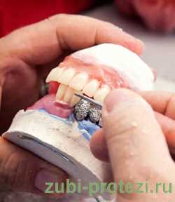 Боль после протезирования зубов