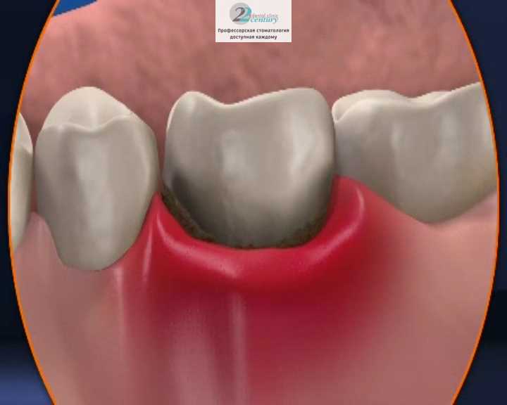 Причины боли зубов под коронкой или протезом