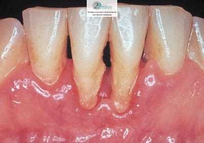 После протезирования зубов — как избежать и справиться с болями
