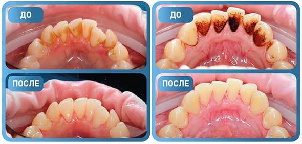 Почему появляются боли после чистки зубов у стоматолога