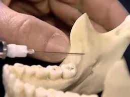 Болит место анестезии зуба