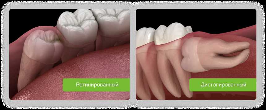 Лечение боли после удаления зуба мудрости — причины и способы облегчения неприятных ощущений