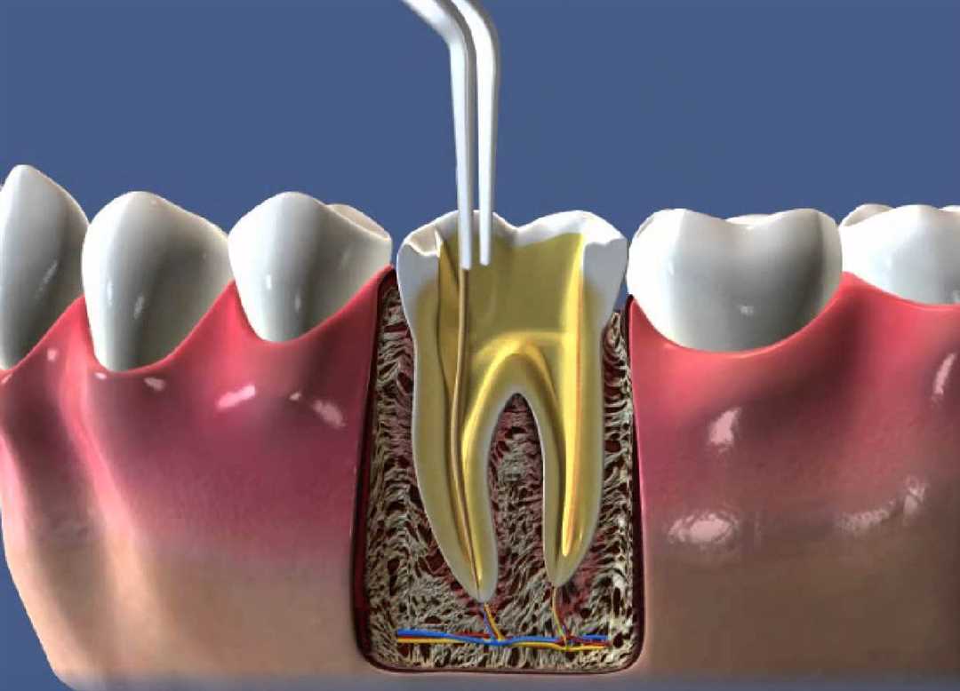 Актуальность лечения зуба после пломбирования каналов