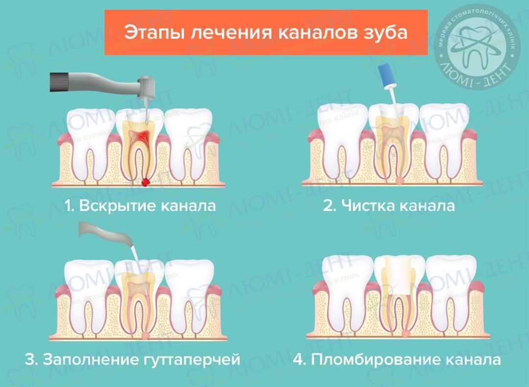 Почему после удаления каналов зуб болит — возможные причины и способы облегчения боли